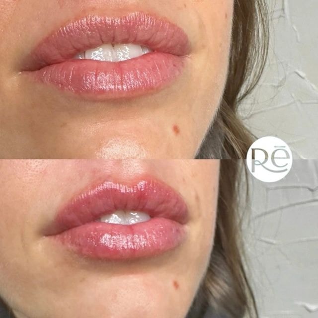 Before and after results collage — ReViVe Aesthetics & Healthcare