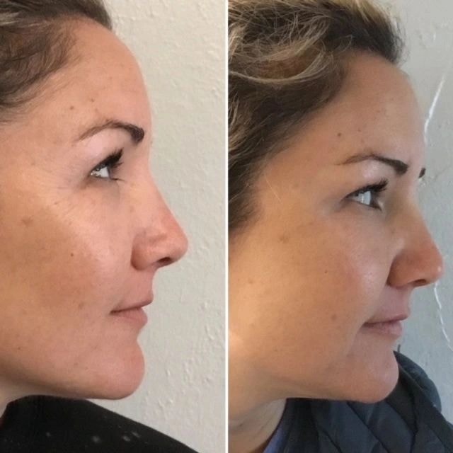 Before and after crow's feet Botox treatment — ReViVe Aesthetics & Healthcare